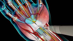 Carpal Tunnel Release Surgery 