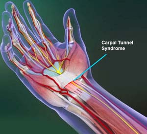 Carpal Tunnel Syndrome  