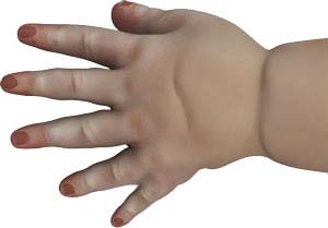 Congenital Defects of the Hand and Wrist 