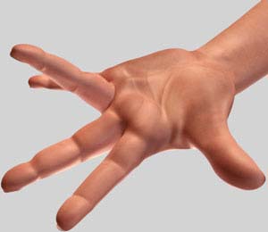 Dupuytren's Contracture 