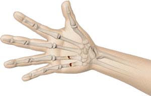 Fractures of the Hand and Fingers 