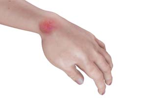 Hand Infections