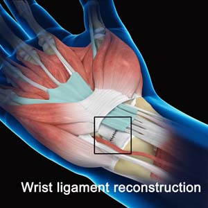 Wrist Ligament Reconstruction 