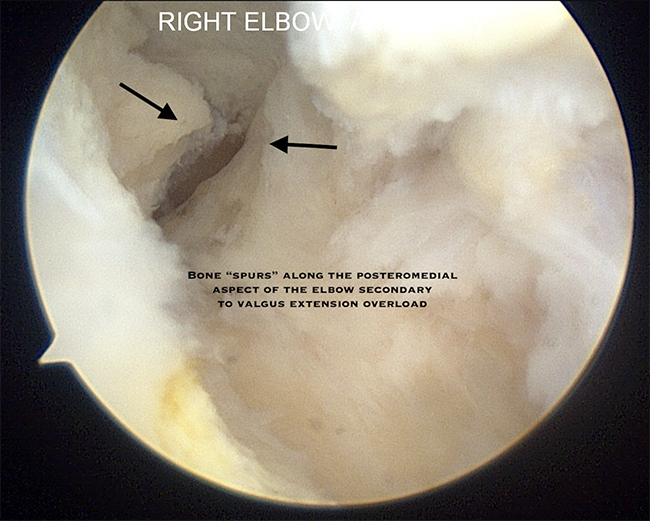 Posterior Medial Impingement/Valgus Extension Overload