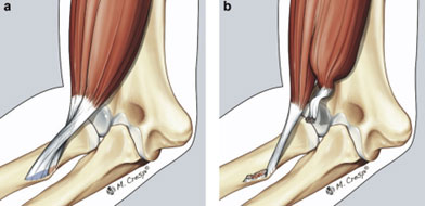 Distal Biceps Injury