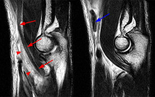 Distal Biceps Injury