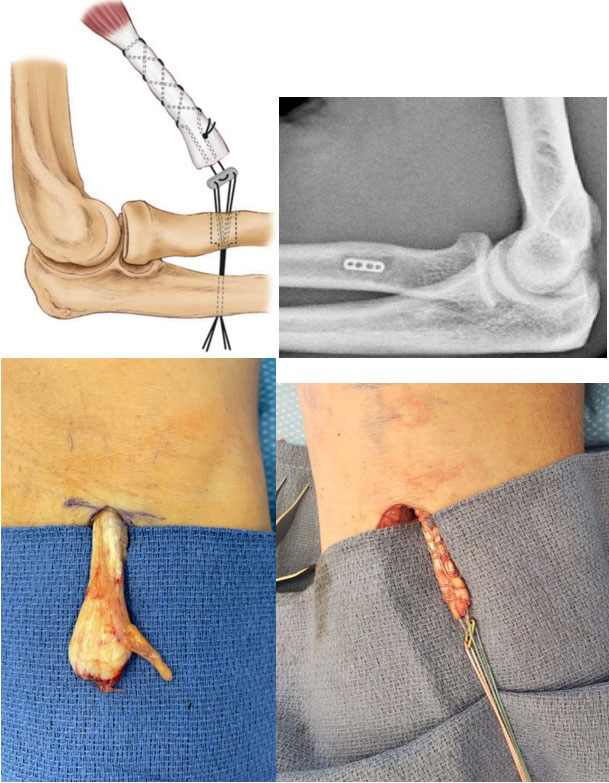 Distal Biceps Injury