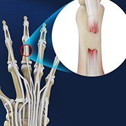 Extensor Tendon Injuries