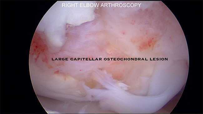 Osteochondritis Dissecans