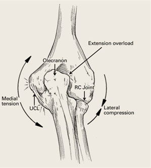 Stress Fracture