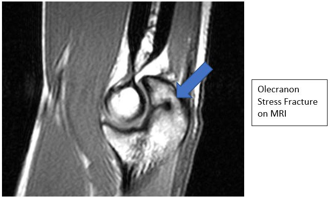 Stress Fracture