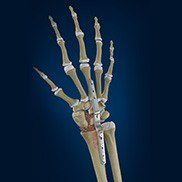 Total Wrist Arthrodesis