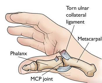 UCL injury