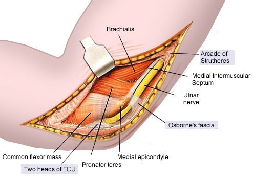 Ulnar Nerve Subluxation