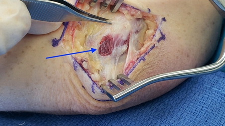 Ulnar Nerve Subluxation