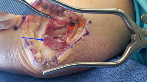 Ulnar Nerve Subluxation