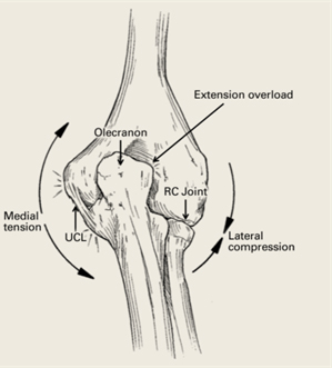 Valgus Extension Overload 