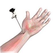 Wrist Arthroscopy