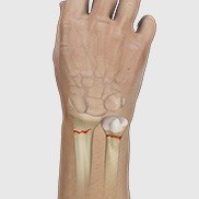 Wrist Fracture Fixation